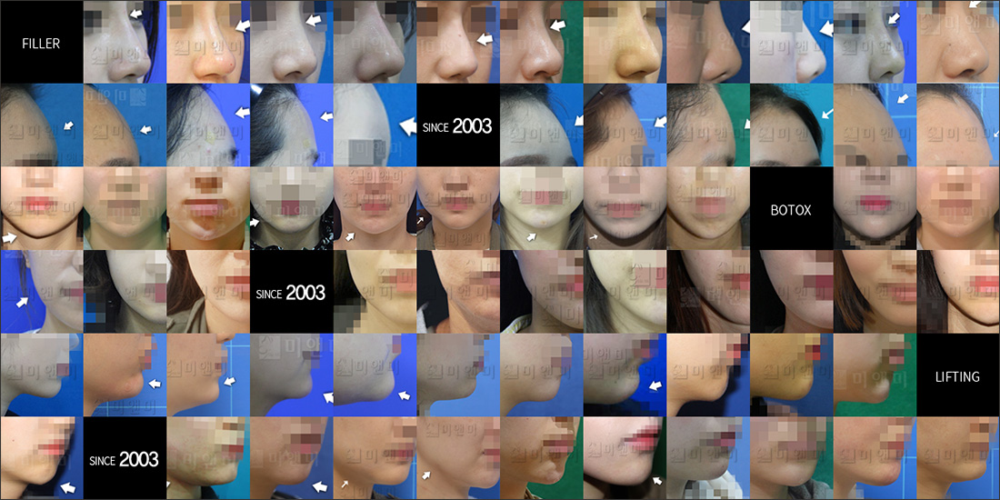 SINCE 2003 MI&MI, 시술후사진모음 평촌윤곽주사,범계역윤곽주사
